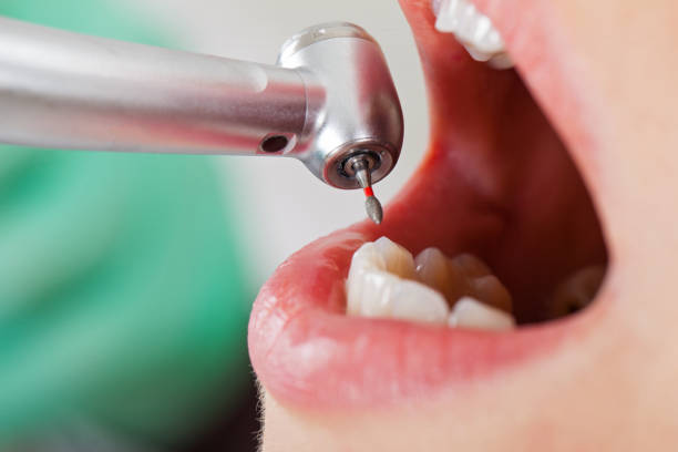 Best Emergency Dentist for Lost Fillings or Crowns in Camden, TN